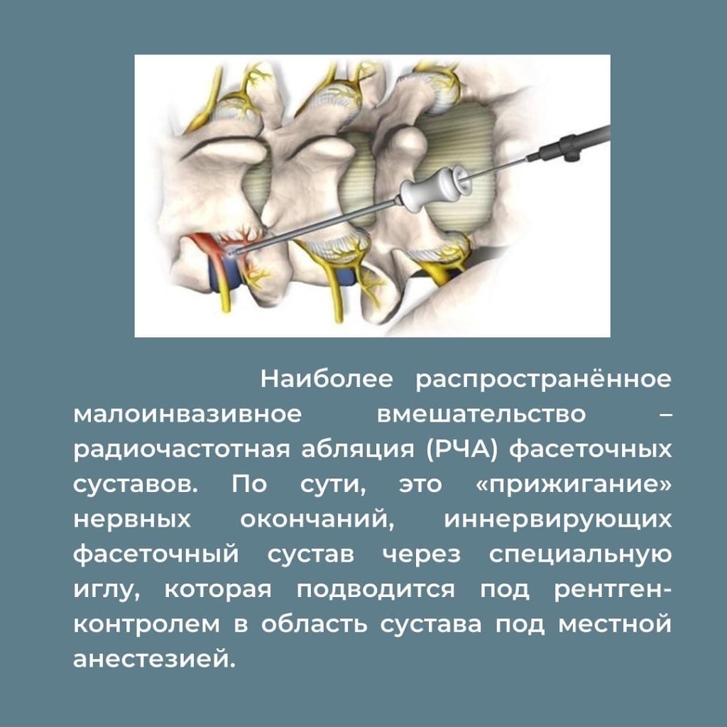 Фасеточная блокада. Фасеточный сустав. Фасеточная боль в пояснице что это.